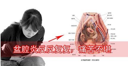 下腹疼痛:女性在急性盆腔炎发病